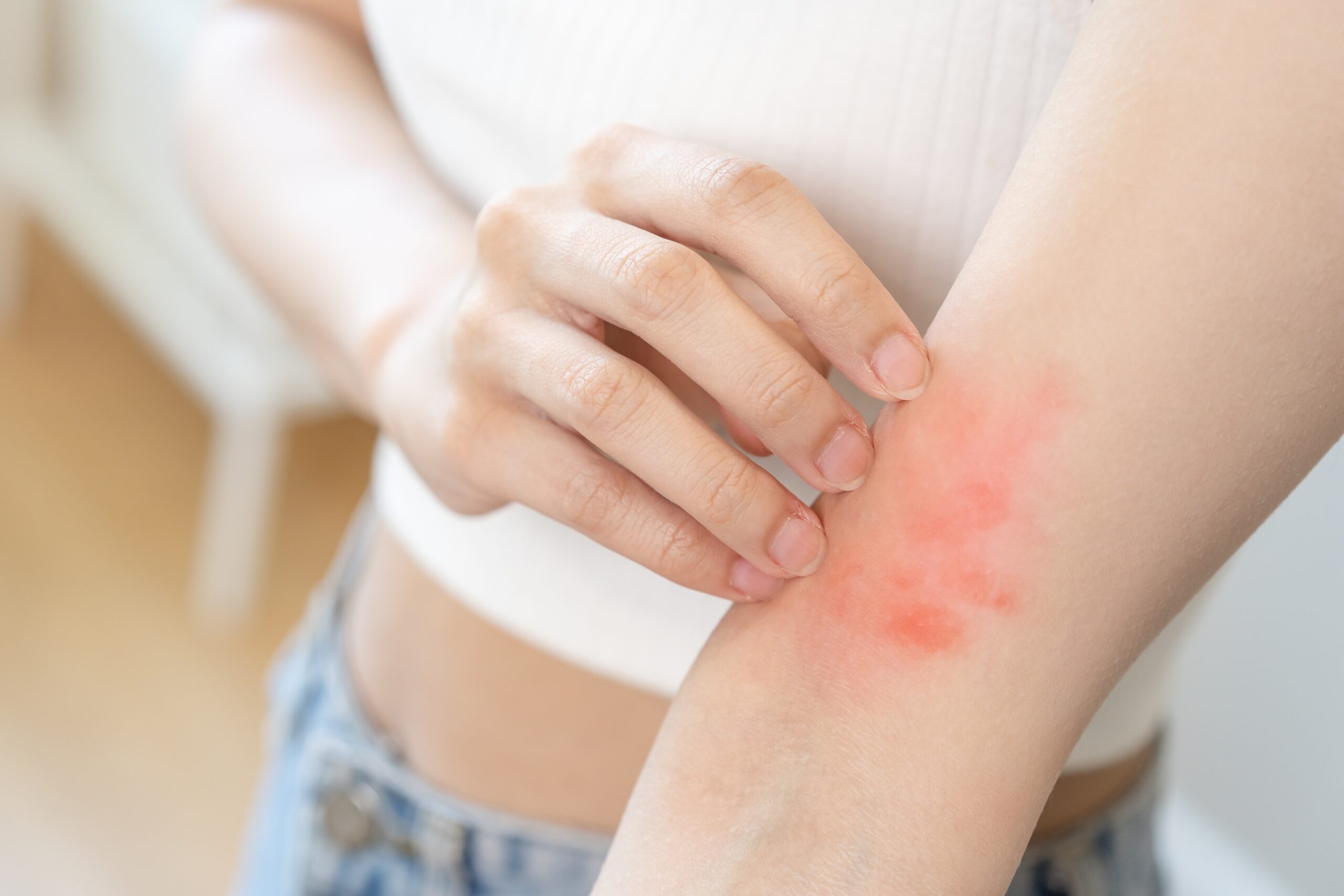 Betnovate cream is used to treat eczema courierpharmacy.co.uk.