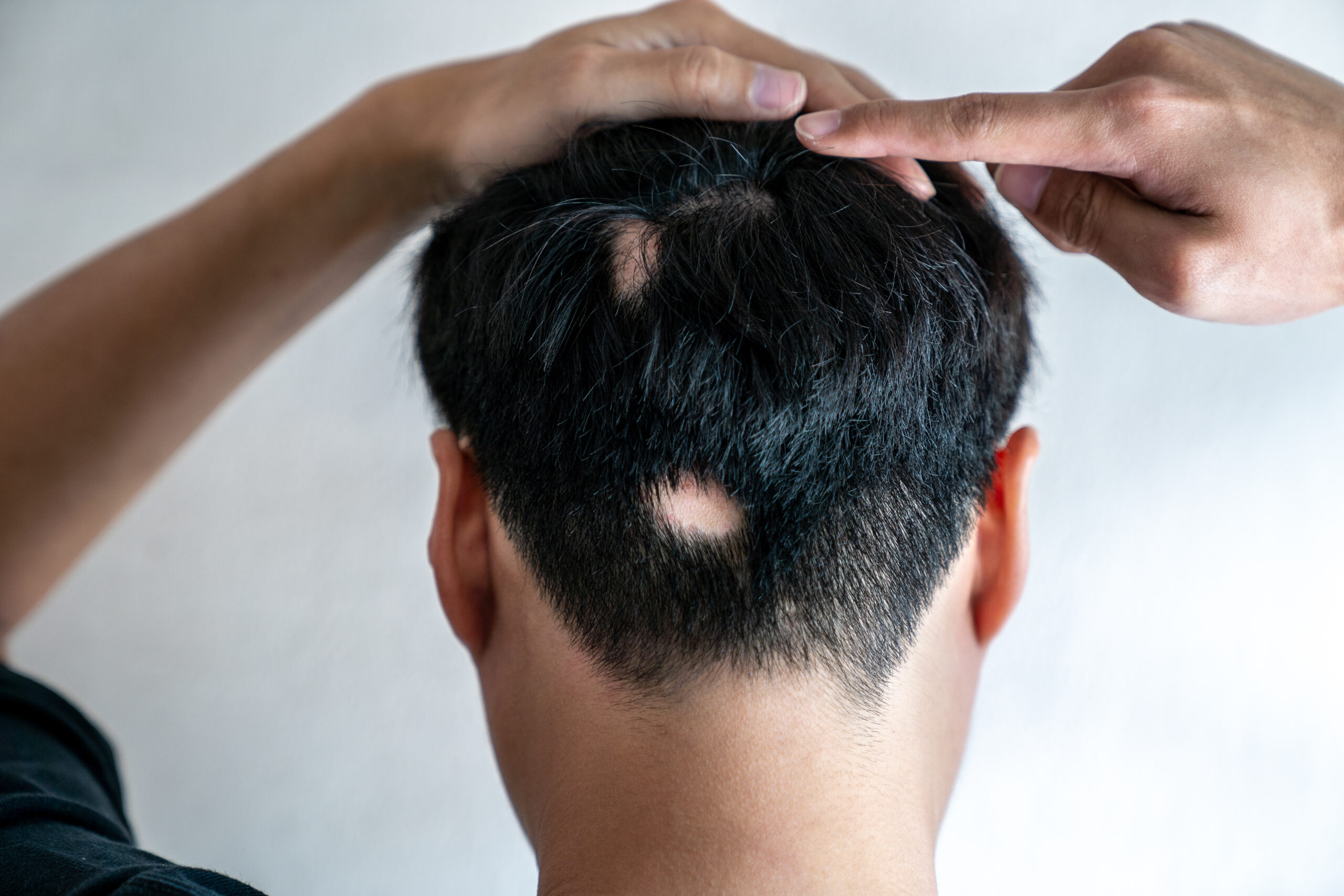 Asian,Guy,Point,His,Hair,Loss.,Alopecia,Areata