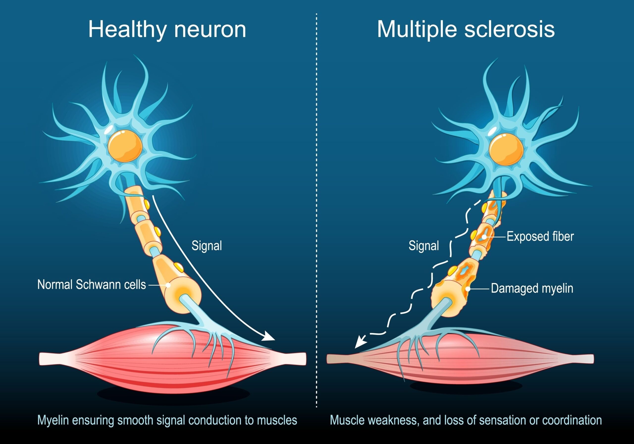 Demyelination in multiple sclerosis courierpharmacy.co.uk (1)