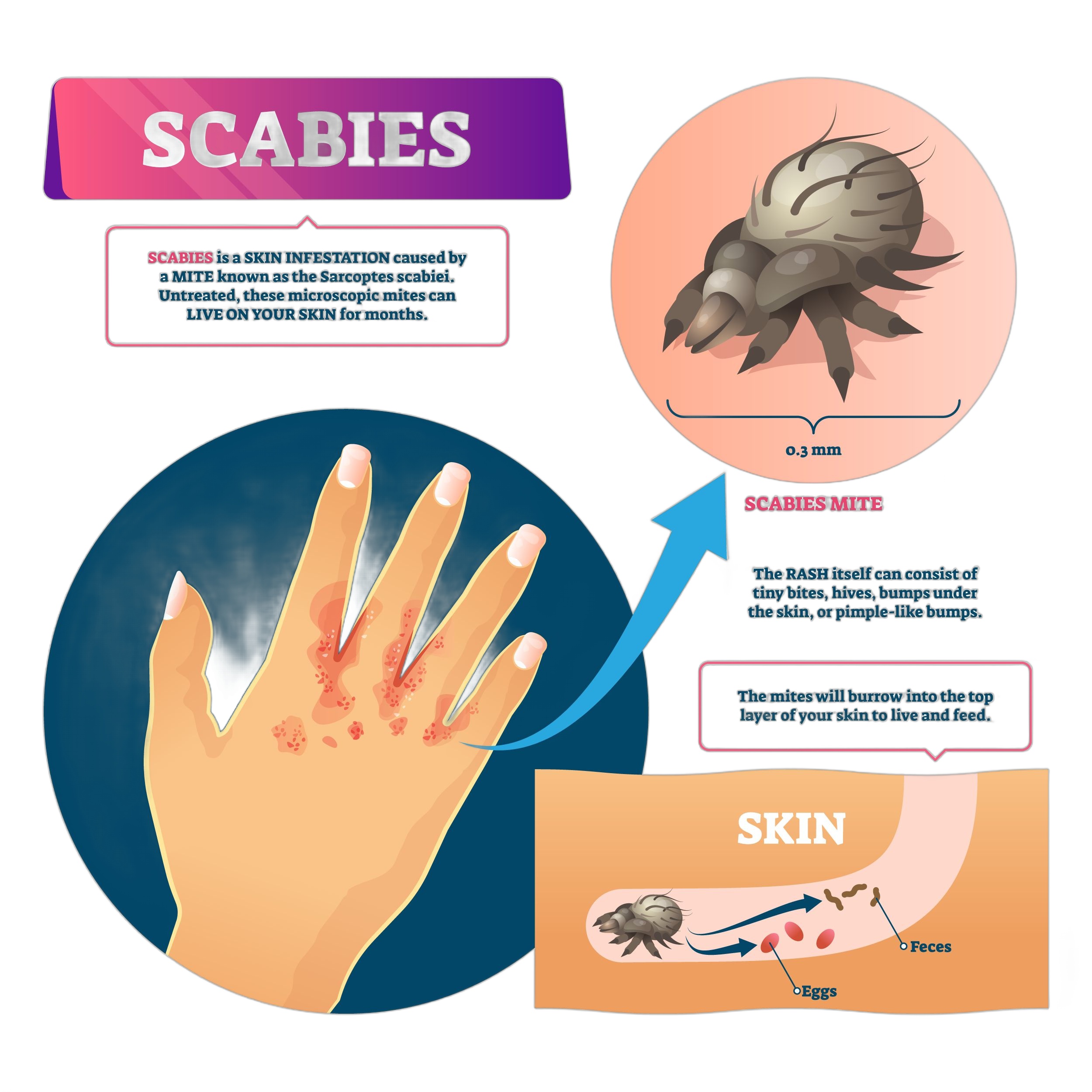Scabies explained courierpharmacy.co.uk